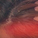 dermatitis seboroik