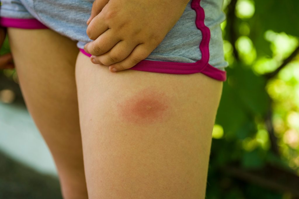 Gejala dan Pengobatan Penyakit Lyme di Indonesia