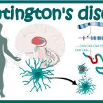 Manajemen Pasien dengan Penyakit Langka Huntington