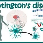 Manajemen Pasien dengan Penyakit Langka Huntington