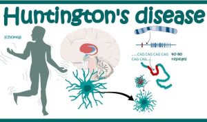 Manajemen Pasien dengan Penyakit Langka Huntington