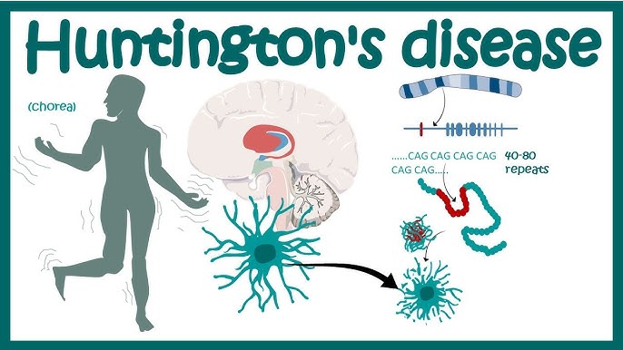 Manajemen Pasien dengan Penyakit Langka Huntington