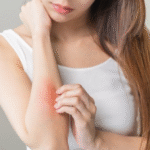 Obat untuk Meredakan Gatal Biduran yang Tidak Mempan CTM Obat untuk Meredakan Gatal Biduran yang Tidak Mempan CTM