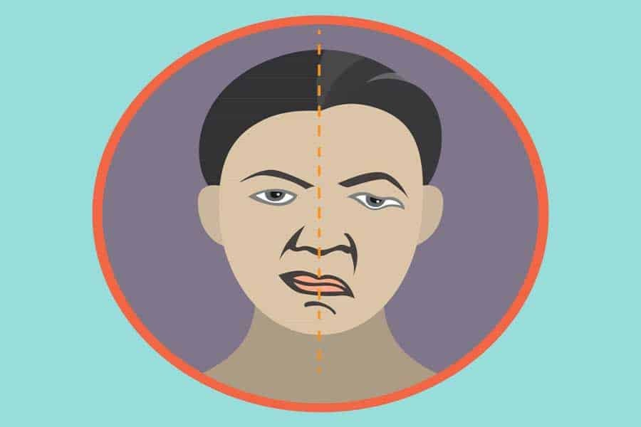 Vitamin Neurotropik untuk Penderita Bell's Palsy